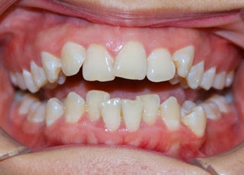 Niềng răng không mắc cài để điều trị răng mọc chen