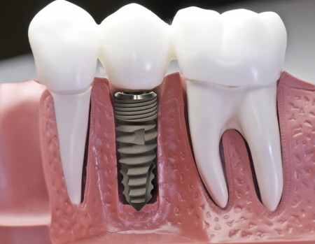 Cấy ghép implant thay thế nhiều răng