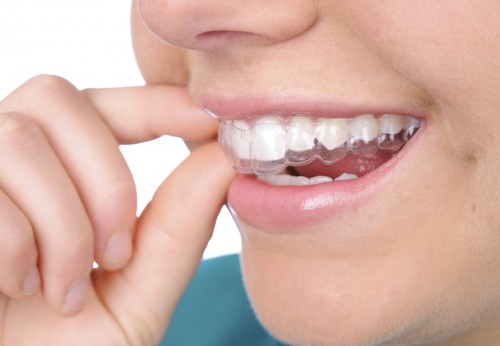 Invisalign phương pháp niềng răng thẩm mỹ