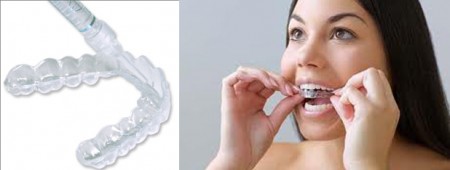 Tẩy trắng răng tại nhà bằng máng tẩy trắng