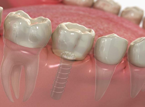 Phương pháp trồng răng implant hoàn hảo nhất