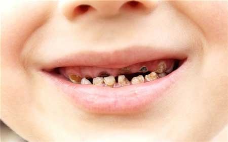 Bệnh sâu răng là gì ?