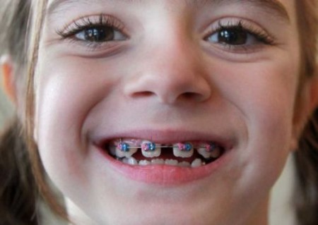 Niềng răng trẻ em có chi phí như thế nào? 