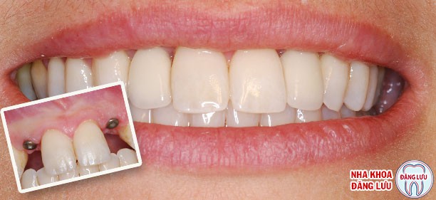 Phục hình răng hiệu quả với implant