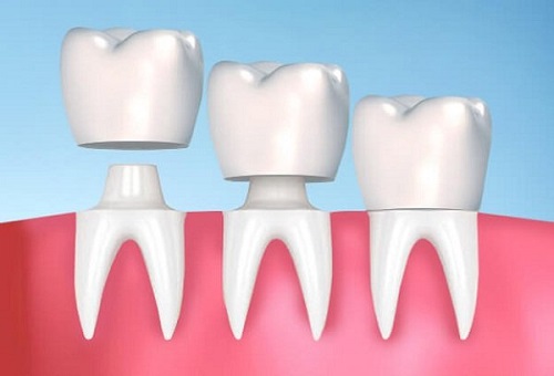 Làm răng sứ có đau không? Tìm hiểu dịch vụ răng sứ