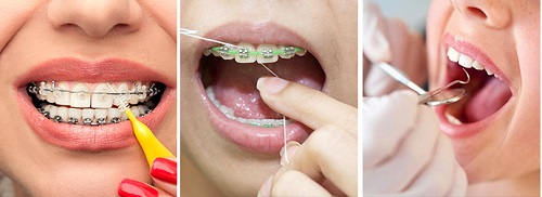 Niềng răng gây hôi miệng - Nguyên nhân và cách xử lý