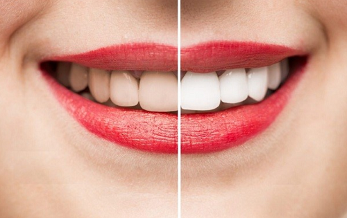 Tẩy trắng răng hút thuốc có sao không? Tìm hiểu ngay 1