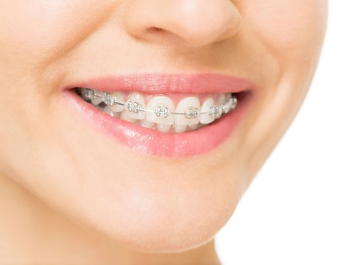 Niềng răng bị viêm lợi do đâu? Cách khắc phục hiệu quả 1