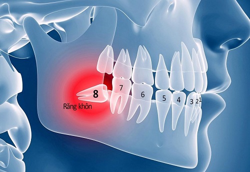 Răng khôn làm sâu răng số 7 - Cách xử lý cho bạn 1