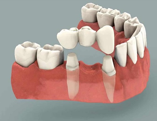 Trồng răng giả có đau không? Các thông tin cần lưu ý 1